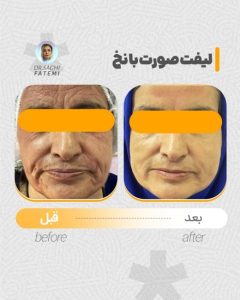 لیفت صورت با نخ