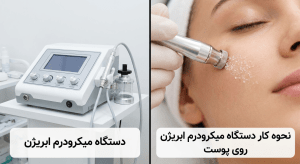 میکرودرم ابریژن در اصفهان