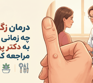 درمان زگیل در اصفهان