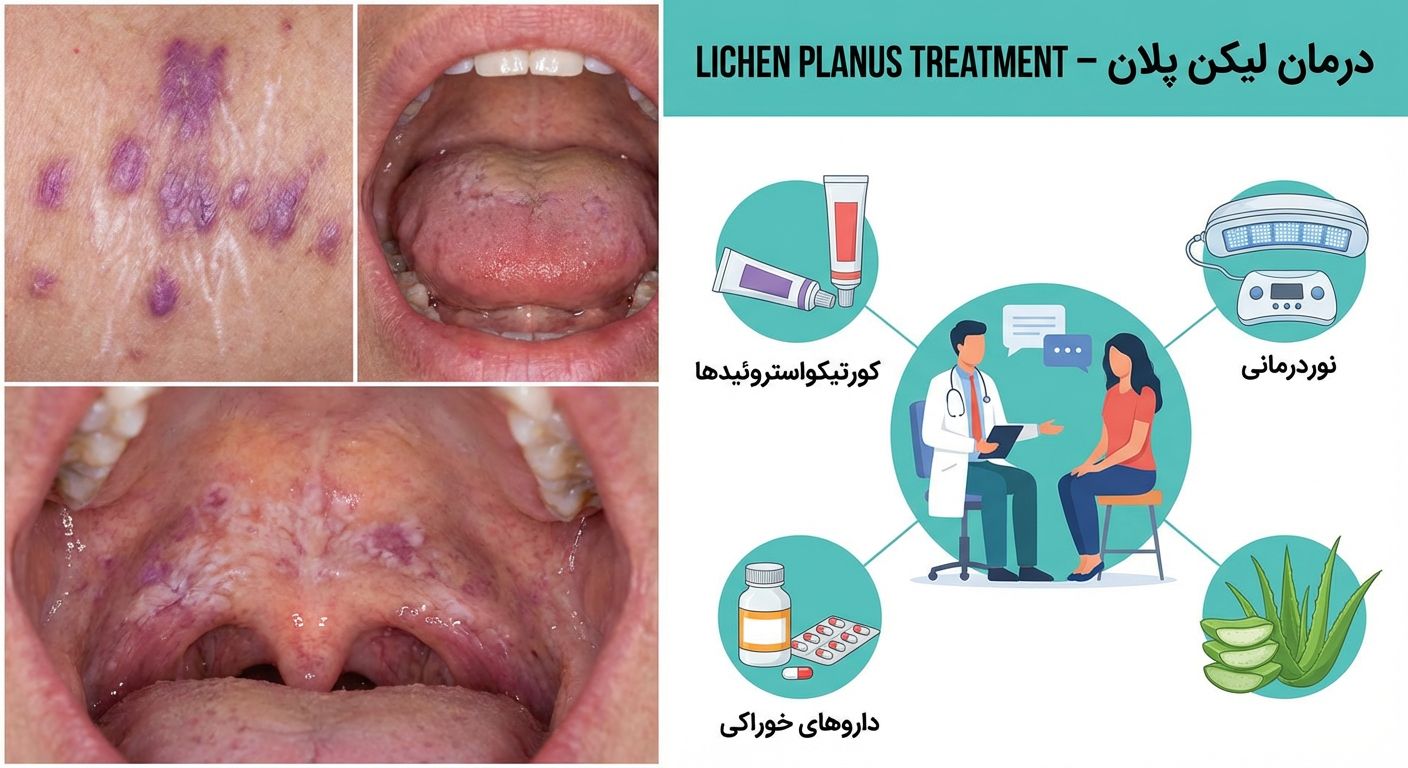درمان لیکن پلان در اصفهان | روشهای نوین و مؤثر در کلینیک دکتر ساقی فاطمی