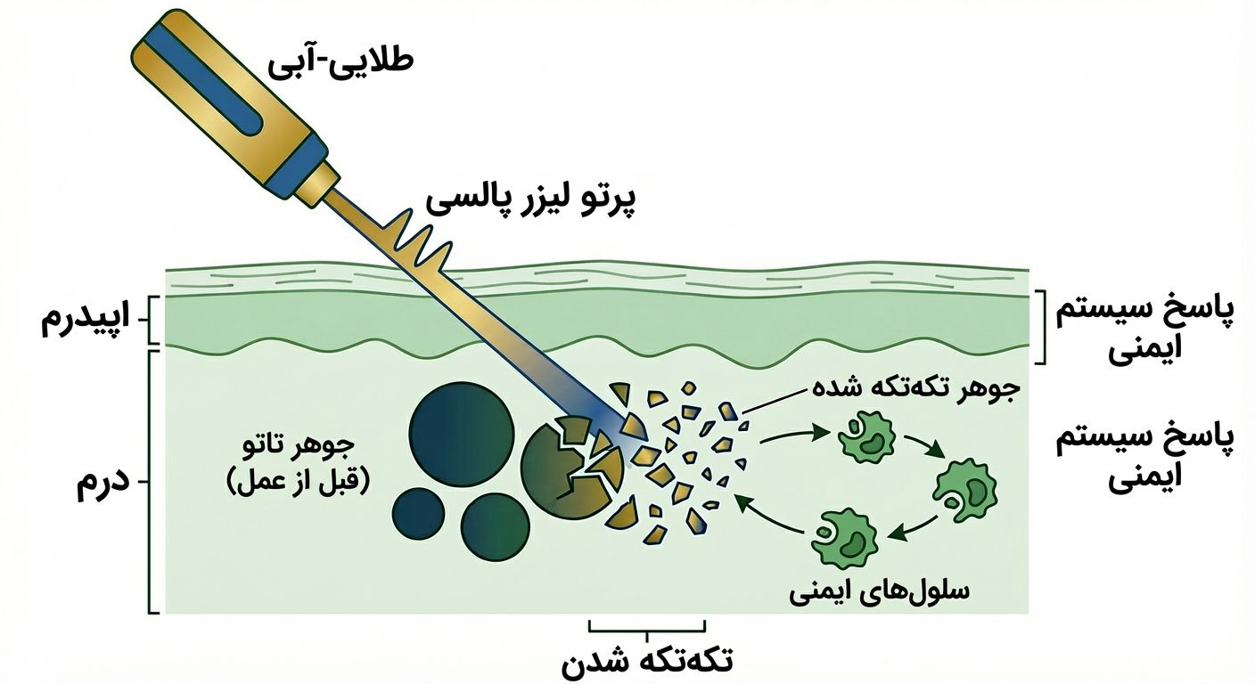 لیزر تتو چیست و چگونه عمل میکند
