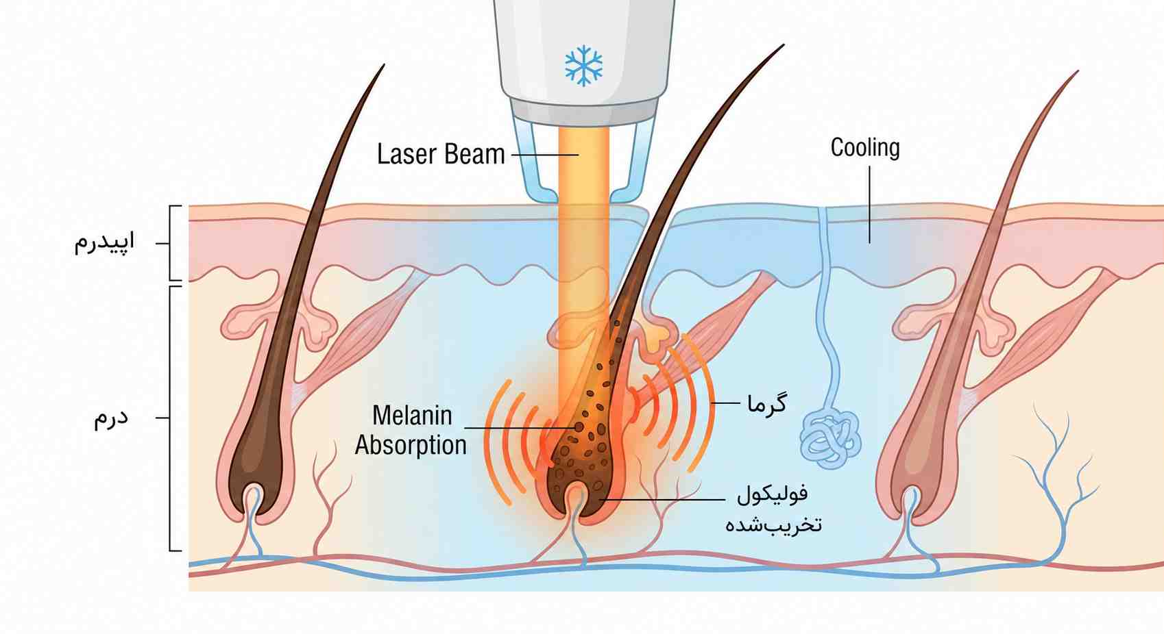 مکانیسم فوتوترمولیز انتخابی در لیزر موهای زائد صورت و جذب نور توسط ملانین فولیکول مو